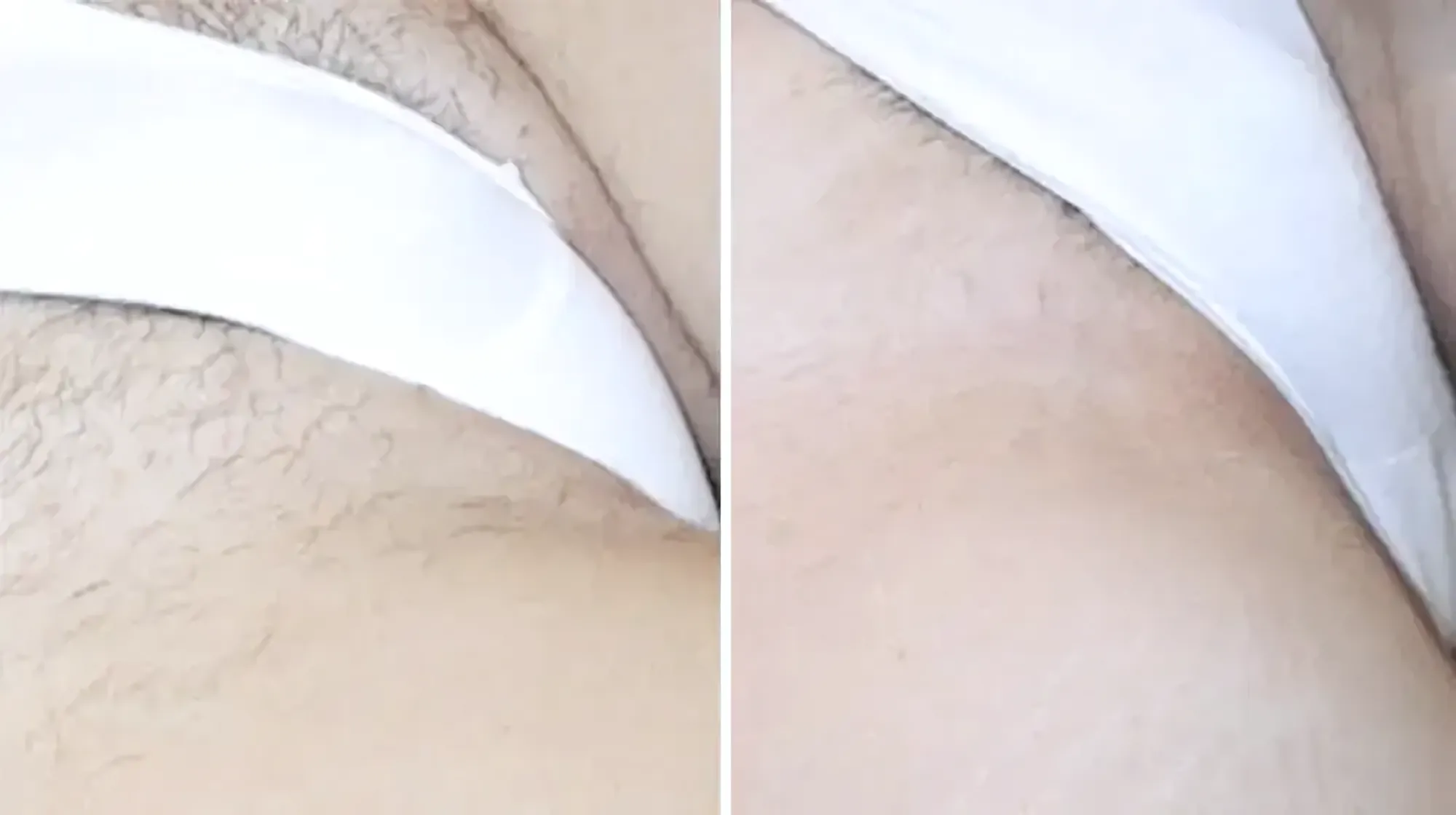 Înainte și după · Epilare Laser Diodă PrimeLase® · CryoMedica Cluj