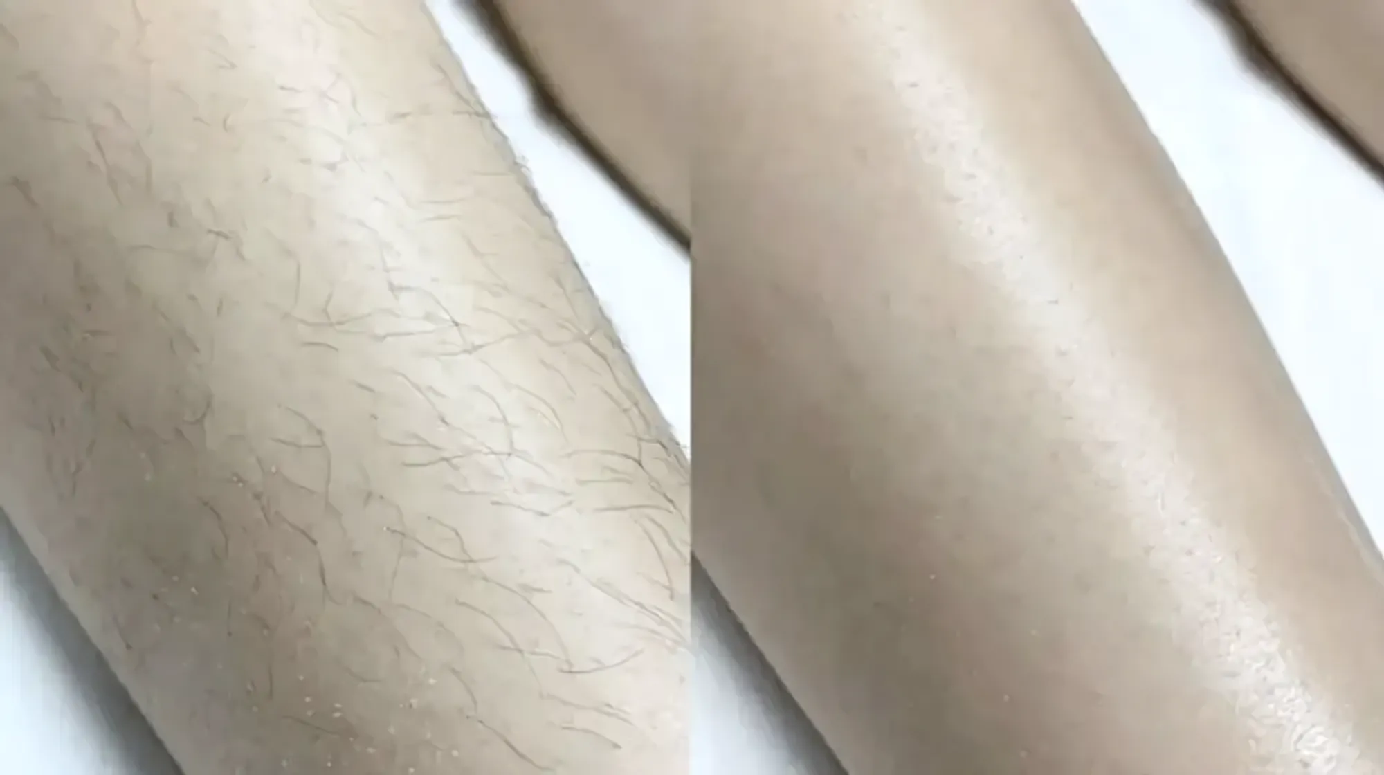 Înainte și după · Epilare Laser Diodă PrimeLase® · CryoMedica Cluj