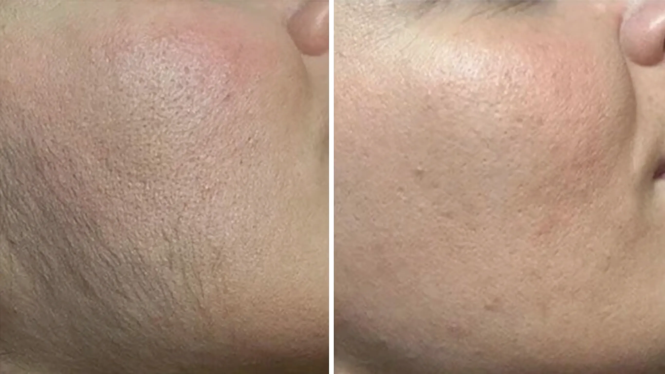 Înainte și după · Epilare Laser Diodă PrimeLase® · CryoMedica Cluj