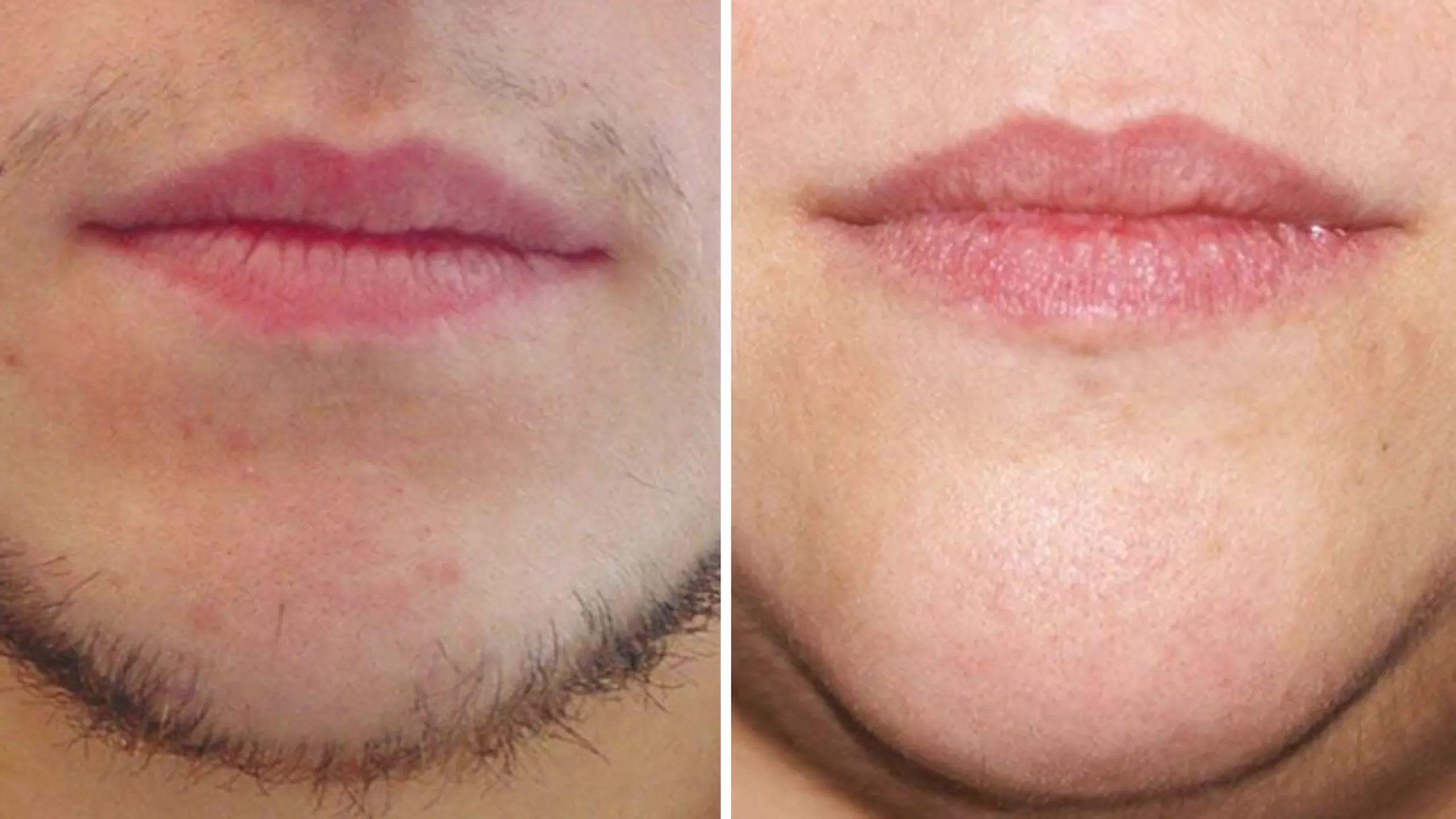Înainte și după · Epilare Laser Diodă PrimeLase® · CryoMedica Cluj