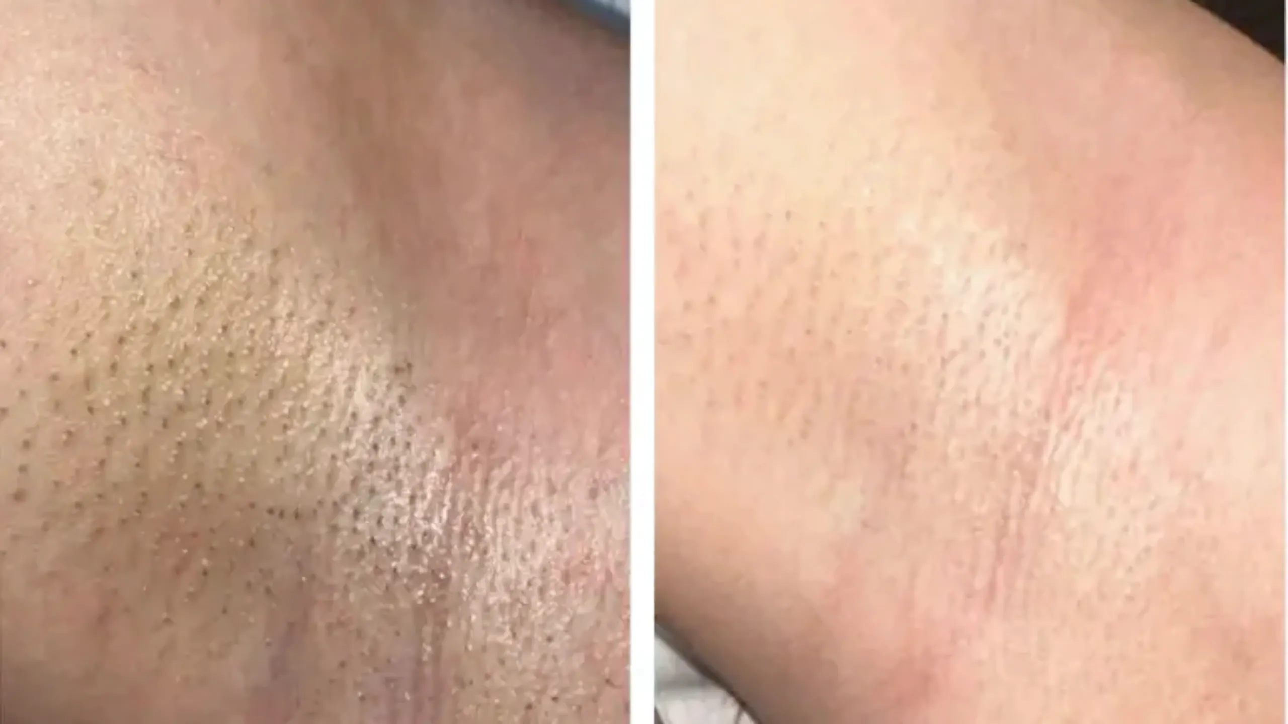 Înainte și după · Epilare Laser Diodă PrimeLase® · CryoMedica Cluj
