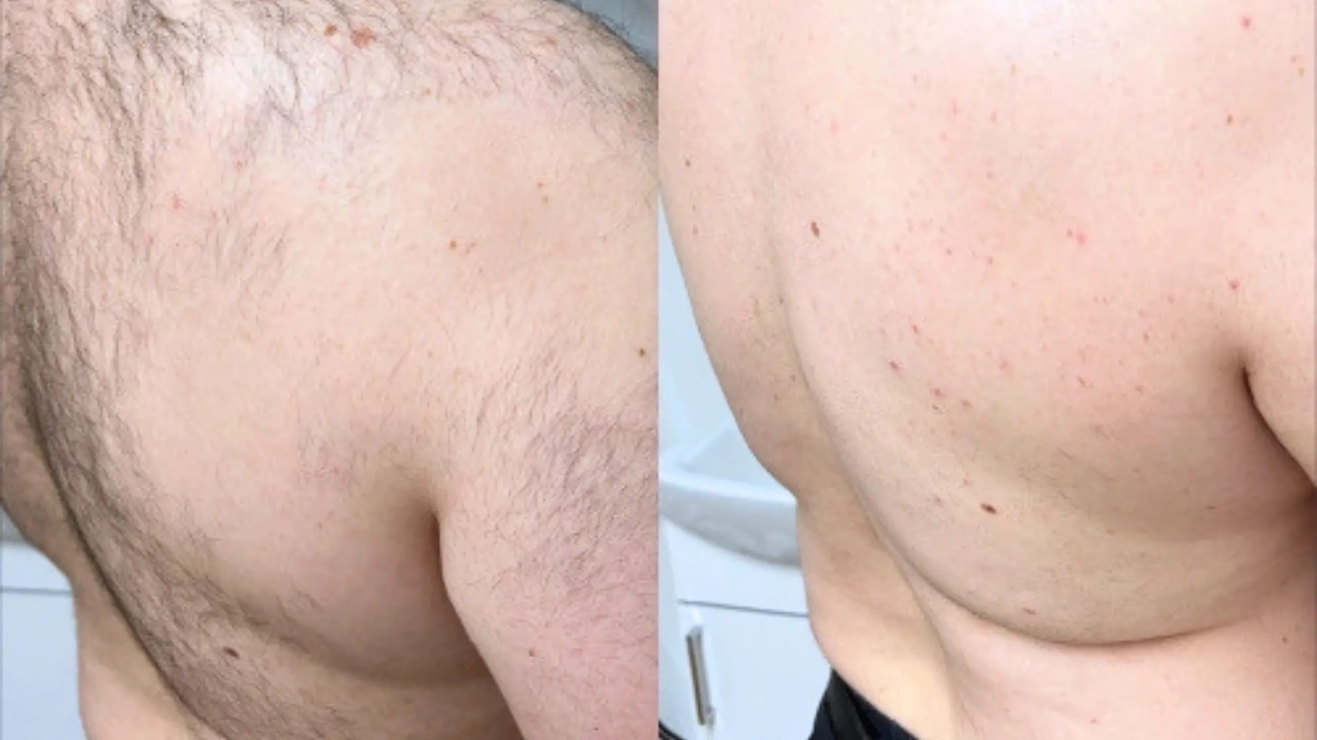 Înainte și după · Epilare Laser Diodă PrimeLase® · CryoMedica Cluj
