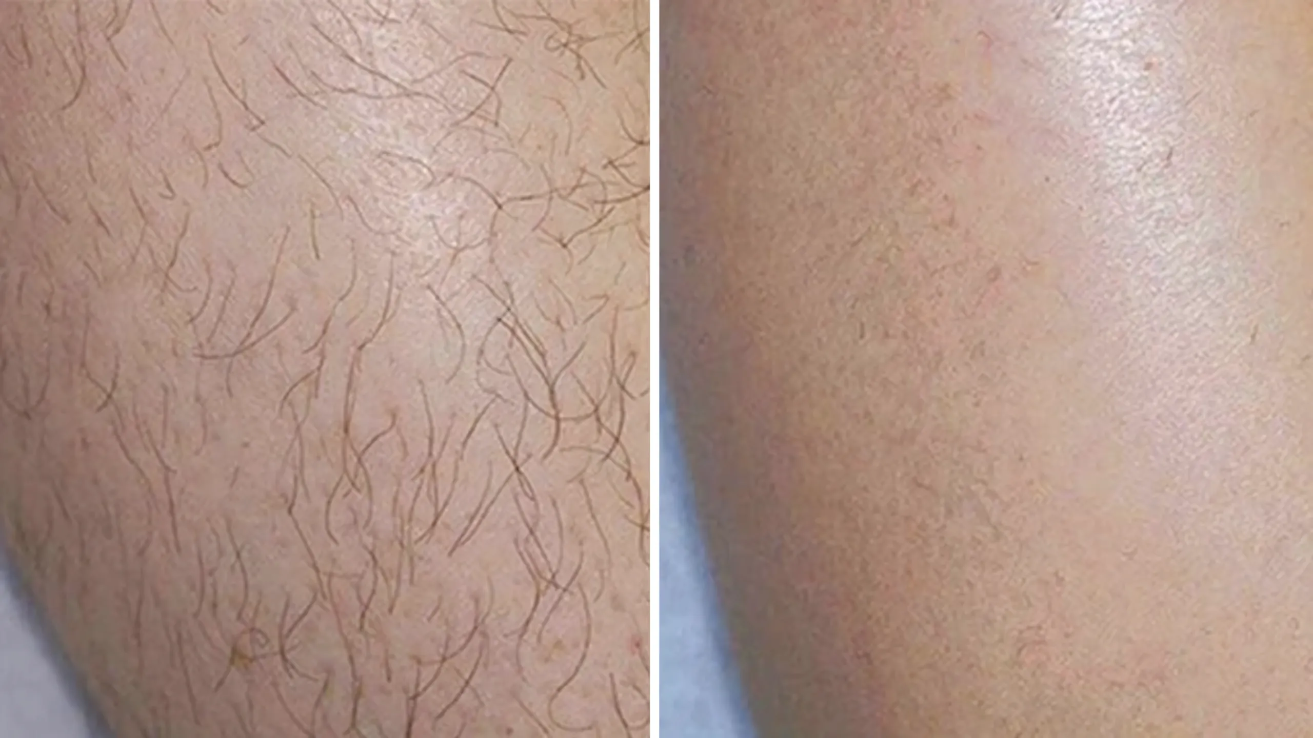 Înainte și după · Epilare Laser Diodă PrimeLase® · CryoMedica Cluj