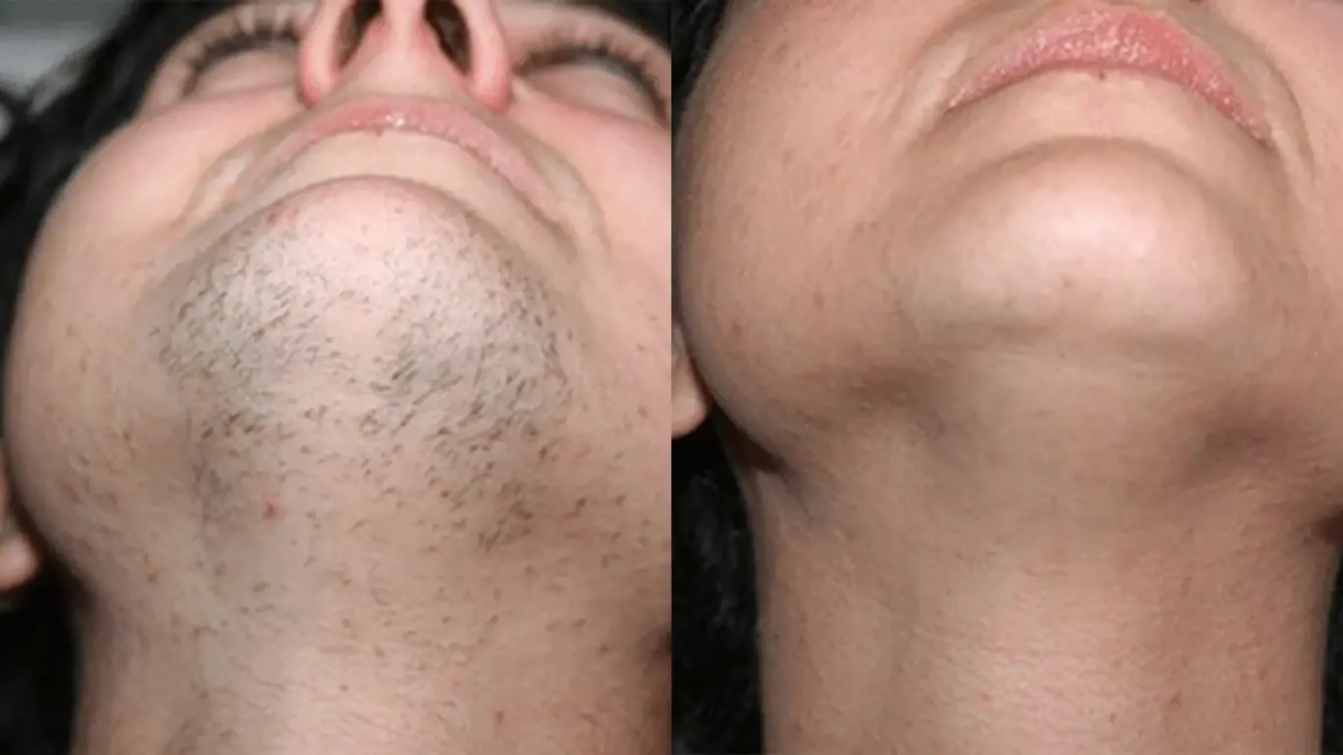 Înainte și după · Epilare Laser Diodă PrimeLase® · CryoMedica Cluj